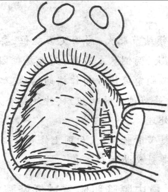 上頜結(jié)節(jié)肥大修整術(shù)